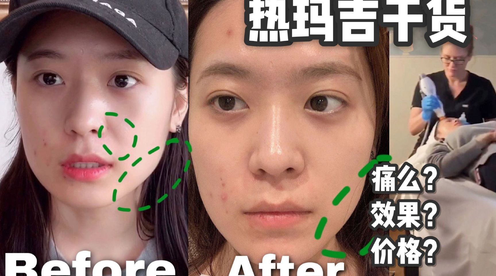 热玛吉干货️真实效果对比...